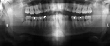 Panoramic radiographic image of a right angle and 