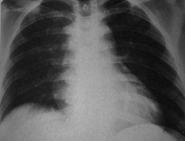 Upright frontal radiograph in the same patient as 