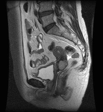 Sagittal T2-weighted magnetic resonance image of s