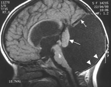 A sagittal T1-weighted magnetic resonance imaging 