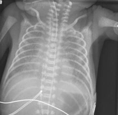 respiratory distress syndrome x ray