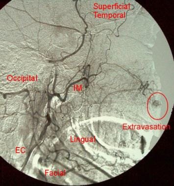 Digital-subtraction angiogram of the right externa