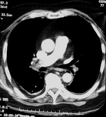 Pulmonary angiography. CT image obtained after the
