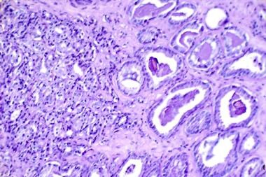 Histologic slide showing prostate cancer (hematoxy