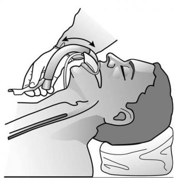 Laryngeal mask airway - Wikipedia