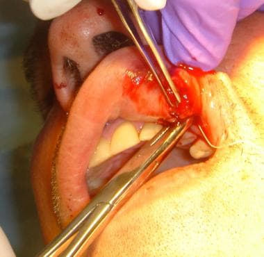 Closure of an intraoral skin laceration. 