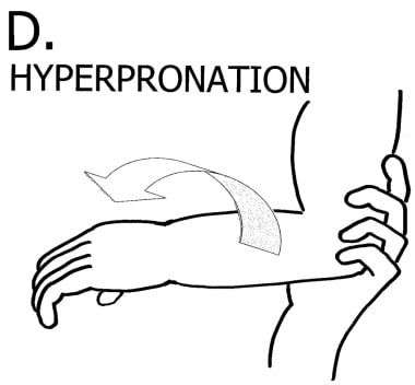 Reduction of subluxated radial head: hyperpronatio