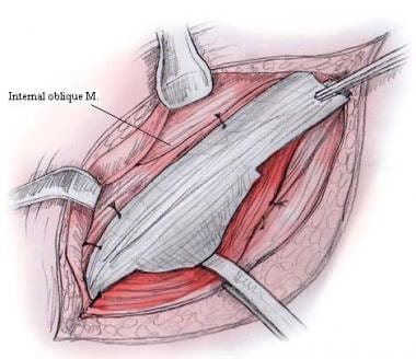 Open inguinal hernia repair. Fixation of upper edg