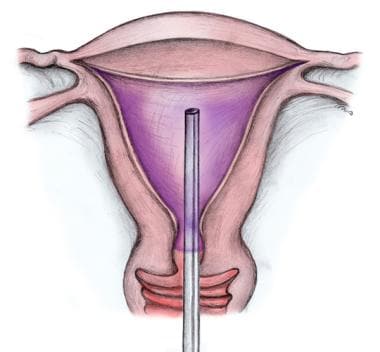 ThermaChoice uterine balloon device. 
