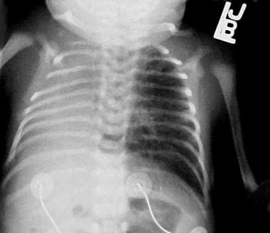 Chest radiograph of a newborn with primary pulmona