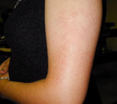 Keratosis pilaris in characteristic location on ou