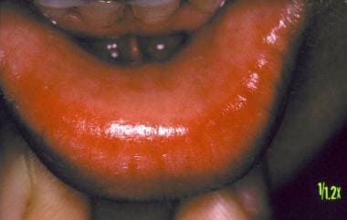 Contact urticaria of the lip due to food allergy. 