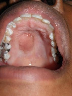 Isolated palatal lesion in a 27-year-old African A