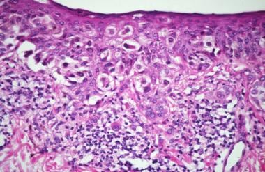 paget disease extramammary melanoma pagetoid spread situ malignant photomicrograph cells pathology outlines workup skin intraepidermal prominent