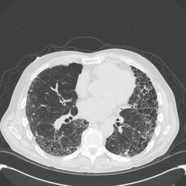 Pathology of usual interstitial pneumonia. Chest c