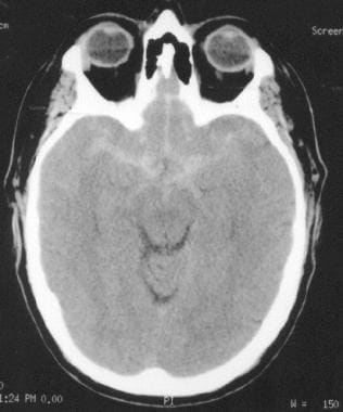 Brain CT scan showing subtle finding of blood at t