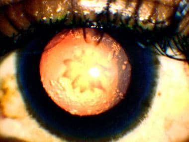 Same cataract as seen in previous image, viewed by