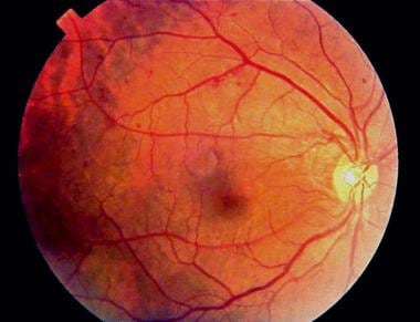 Fundus photograph of early background diabetic ret