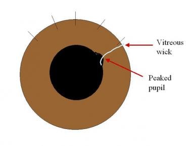 Externalized vitreous with a peaked pupil. Image c