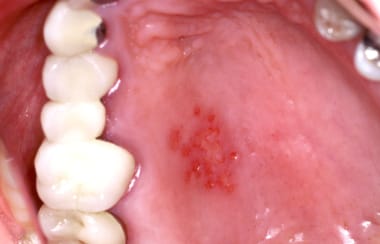 Viral Infections of the Mouth Clinical Presentation: History and ...