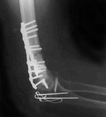 Lateral radiograph of a supracondylar-intracondyla