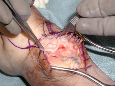 Volar cyst from pisotriquetral joint. 