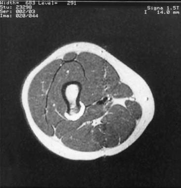 Solitary osteochondroma. MRI of sessile osteochond
