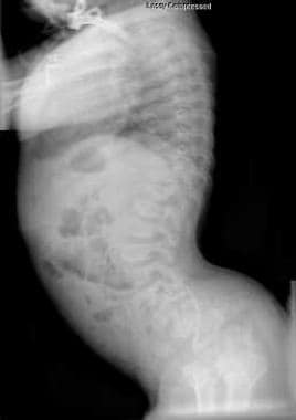 Spondyloepiphyseal dysplasia. Radiograph of the sp