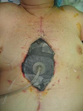 TW GORE) My nipple necrosis journey so far- almost 6 weeks post op