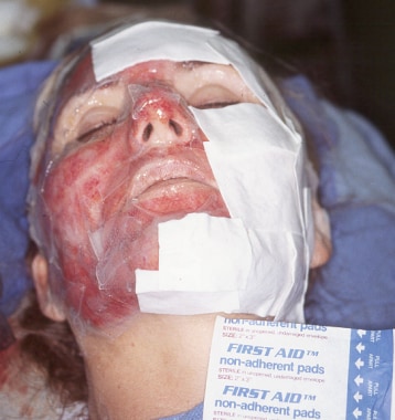 Dressing for full-face dermabrasion is shown. 