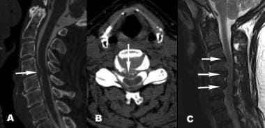 Large central disk herniations (A, B) and cervical