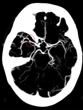 Maximum intensity projection (MIP) image from a co