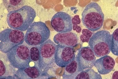 Bone marrow aspirate demonstrating plasma cells of