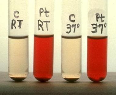 The Ham test (acidified serum lysis) establishes t