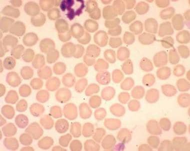 血液涂片显示红细胞中有巴贝斯虫