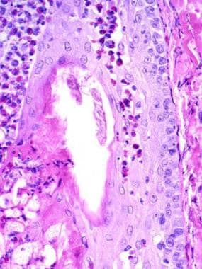 eosinophilic pustular folliculitis histology