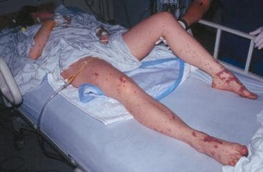 The legs of a 22-year-old woman in septic shock wi