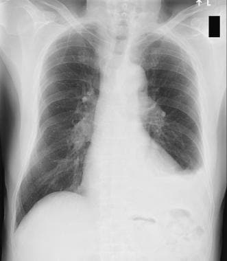 Chest radiograph showing left-sided pleural effusi
