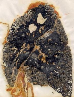 Coal workers' pneumoconiosis (black lung disease).