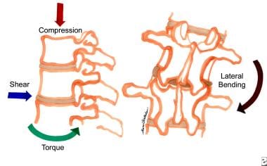 Lumbar Compression Fracture: Practice Essentials, Pathophysiology,  Epidemiology