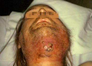 Cutaneous fistula due to a dental infection that c