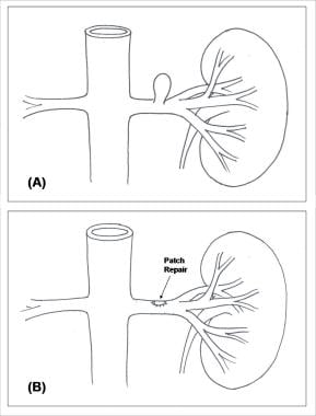 Beads on a String - Renal Fellow Network