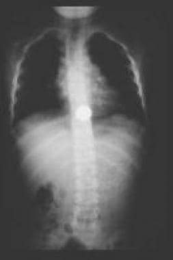 Coin lodged at the lower esophageal sphincter. 