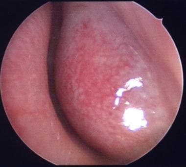 Boggy inferior turbinate in an allergic patient. 