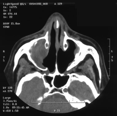 CT scan of a patient with a natural killer (NK)/T-