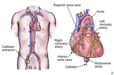 The heart catheterization. 