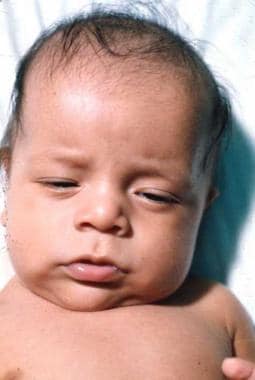 Congenital Hypothyroidism. Infant a few months aft