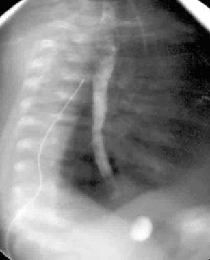 Congenital Anomalies Of Esophagus Treatment & Management: Approach ...