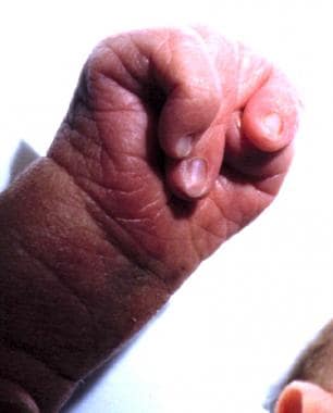 Note the characteristic clenched hand of trisomy 1