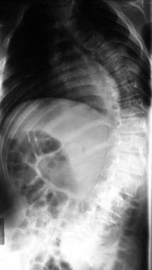 Severe typical scoliosis. 
